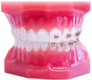 clear braces leatherhead|Invisible & Transparent Braces Philippines .
